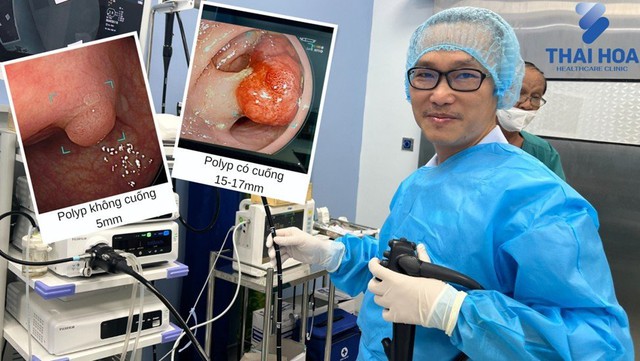 Nội soi cắt polyp đại tràng để dự phòng biến chứng ung thư tại PKĐK Thái Hòa - Ảnh 1.