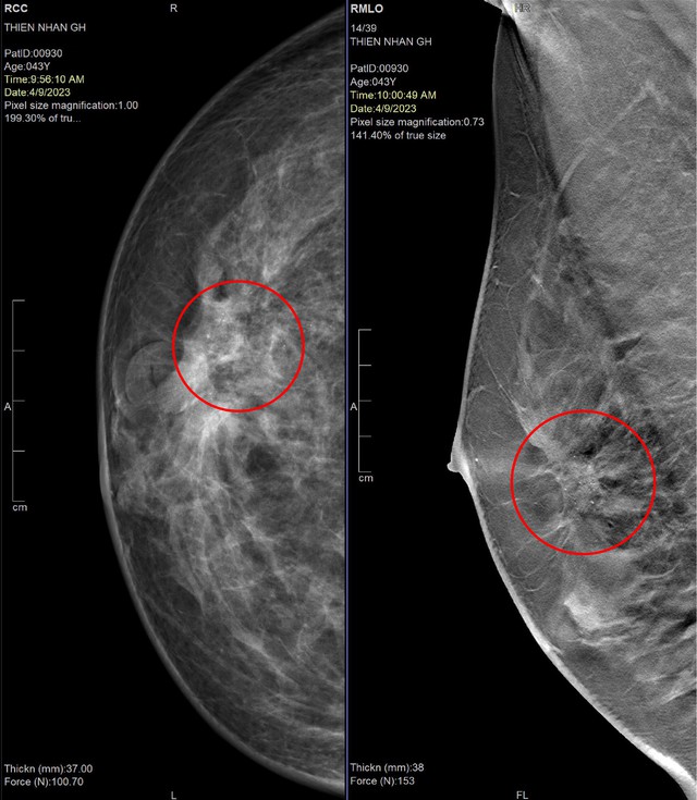 Phát hiện ung thư ở cả 2 vú khi chụp nhũ ảnh 3D - Ảnh 1.