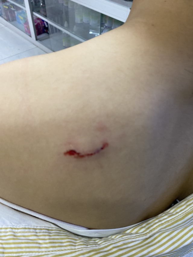 TP.HCM: Cô gái trẻ bị giật điện thoại ngã khỏi xe máy còn bị chó cắn - Ảnh 2.