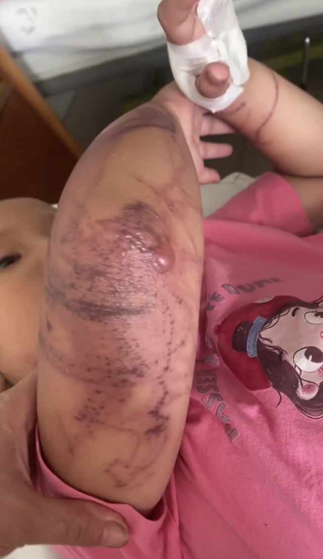 Bé gái 7 tuổi bị sứa đốt tím bầm cánh tay khi tắm biển Nha Trang - Ảnh 1.