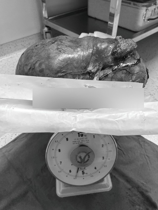 Phẫu thuật cho nam bệnh nhân bị khối u thận 5,5 kg - Ảnh 1.