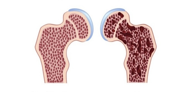 Xương thủy tinh là bệnh gì? - Ảnh 1.