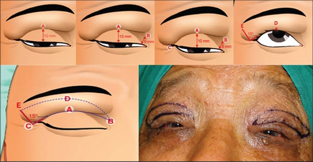 Tạo hình phẫu thuật thẩm mỹ mắt, hiểu đủ, chọn đúng để có đôi mắt đẹp, khỏe - Ảnh 5.