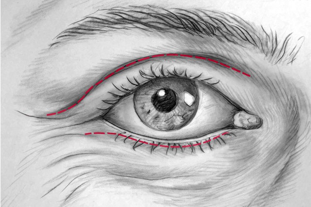 Tạo hình phẫu thuật thẩm mỹ mắt, hiểu đủ, chọn đúng để có đôi mắt đẹp, khỏe - Ảnh 3.