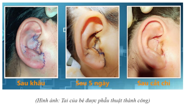 Tạo hình vành tai gần đứt lìa cho bé gái 12 tuổi bị tai nạn giao thông - Ảnh 1. Tạo hình vành tai gần đứt lìa cho bé gái 12 tuổi bị tai nạn giao thông - Ảnh 1.