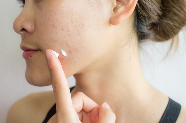 Salicylic Acid là gì? Công dụng và cách sử dụng hiệu quả ngăn ngừa kích ứng - Ảnh 3.