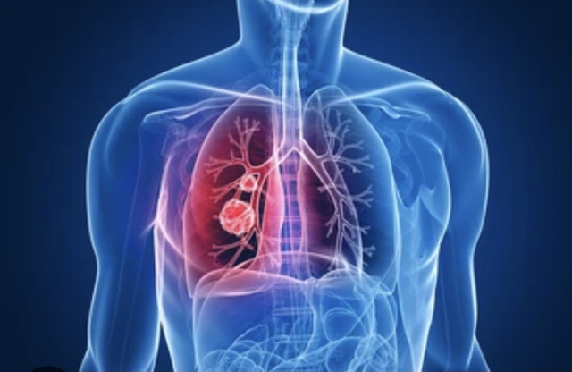 Đột phá: Loại thuốc có khả năng giảm 51% ca tử vong do ung thư phổi - Ảnh 2.