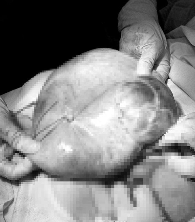 Quảng Bình: Phẫu thuật khối u buồng trứng nặng 5kg cho người phụ nữ 50 tuổi - Ảnh 1.