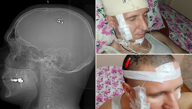 Người đàn ông Nga tự khoan hộp sọ để cấy thiết bị 'điều khiển giấc mơ' - Ảnh 1.
