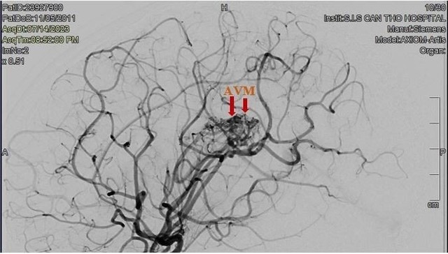 Đau đầu, nôn ói, chán ăn, đến bệnh viện phát hiện vỡ dị dạng mạch máu não - Ảnh 2.