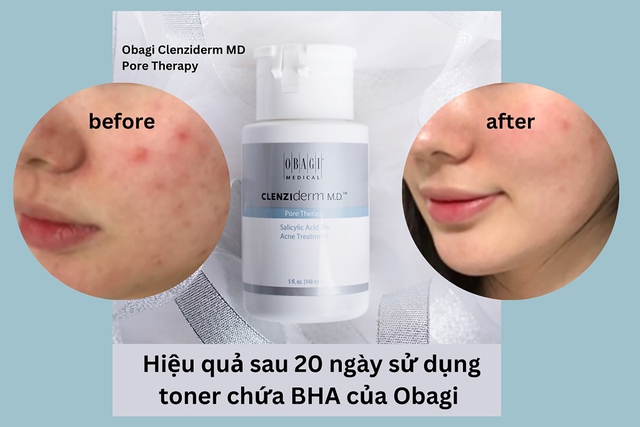 Review BHA Obagi Clenziderm MD Pore Therapy và cách sử dụng đúng chuẩn ngừa kích ứng - Ảnh 3.