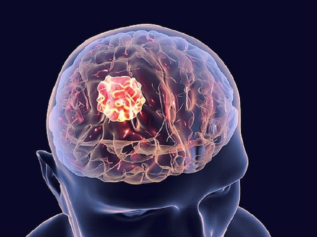Bất ngờ đổi tính, đi khám mới biết mắc khối u não lớn bằng trái cam - Ảnh 1.