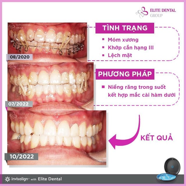  Khớp cắn ngược: Niềng răng khay trong suốt có hiệu quả không?  - Ảnh 4.