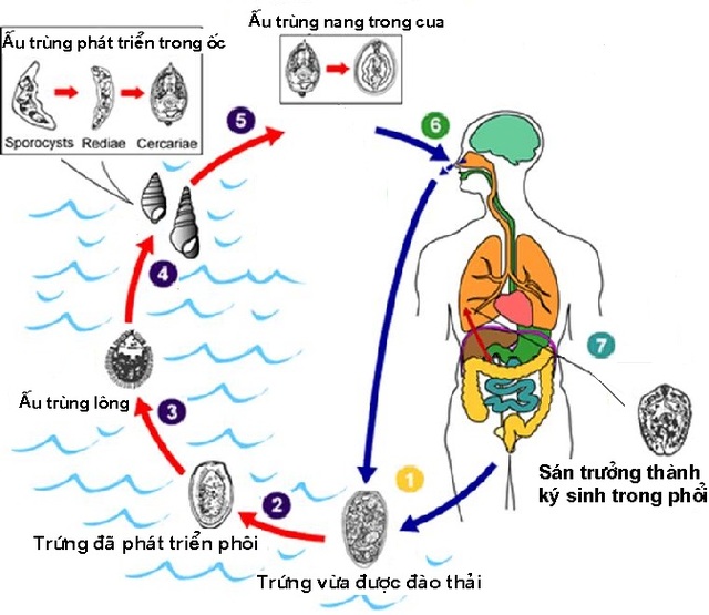  Ăn gỏi cua, nam thanh niên nhiễm sán lá phổi - Ảnh 1.