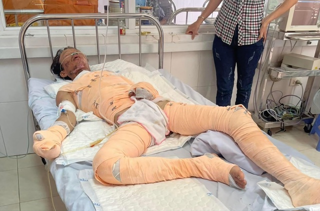 Lá lành đùm lá rách: Người phụ hồ nghèo bị bỏng điện nguy kịch - Ảnh 1. Lá lành đùm lá rách: Người phụ hồ nghèo bị bỏng điện nguy kịch - Ảnh 1.
