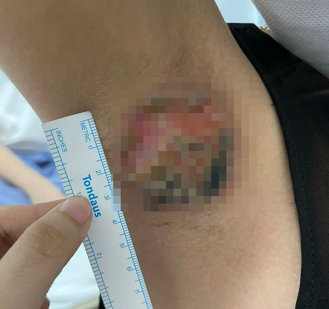 Nhiều ca hoại tử, 'cháy đen' nách do đốt điện trị hôi nách ở spa - Ảnh 1. Nhiều ca hoại tử, 'cháy đen' nách do đốt điện trị hôi nách ở spa - Ảnh 1.