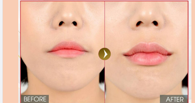 Được và mất khi sử dụng filler để trẻ hóa đôi môi, tạo hình môi  - Ảnh 3.