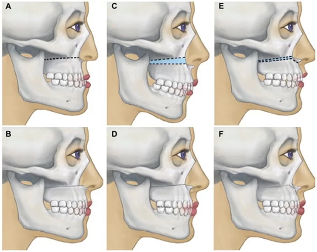 Khám, nắn chỉnh răng cho trẻ kịp thời tránh bị răng vẩu, hàm hô phải thu gọn - Ảnh 2.