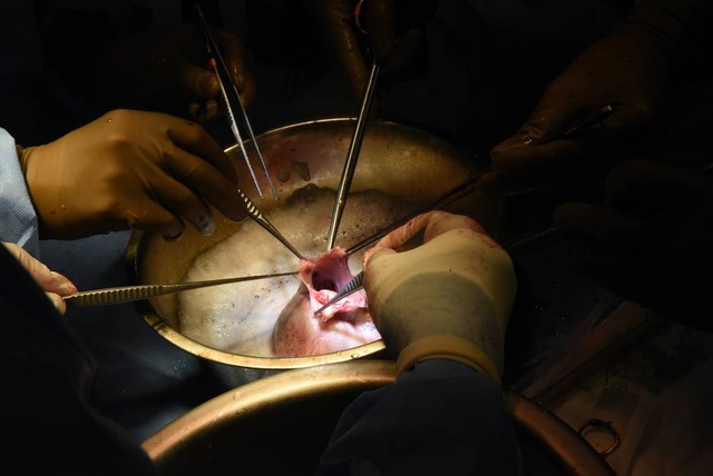 Bệnh nhân thứ 2 trên thế giới được cấy ghép tim lợn - Ảnh 1.