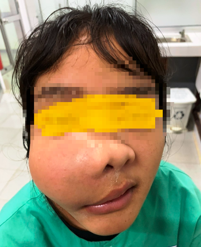 Phẫu thuật thành công khối u vùng mặt lớn rất hiếm gặp cho bệnh nhân 17 tuổi - Ảnh 1.