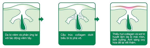 Cơ chế hình thành sẹo lõm