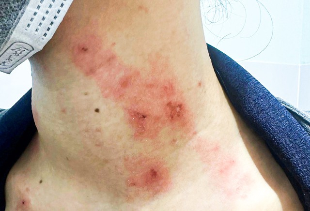 Nhiều người bị nhiễm độc, viêm da tiếp xúc do kiến ba khoang nhưng nhầm Zona - Ảnh 2. Nhiều người bị nhiễm độc, viêm da tiếp xúc do kiến ba khoang nhưng nhầm Zona - Ảnh 2.