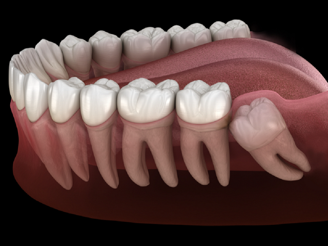 Dấu hiệu cảnh báo răng khôn đến lúc cần nhổ- Ảnh 1.