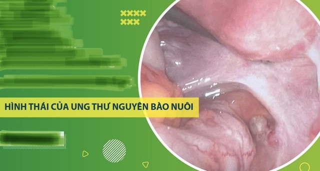 Sản phụ mang thai khối ung thư hiếm gặp- Ảnh 1.