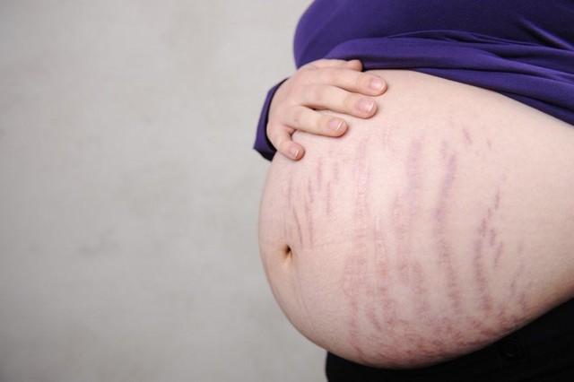 Bí quyết phòng ngừa, điều trị rạn da trước và sau khi sinh của mẹ 3 con- Ảnh 2.