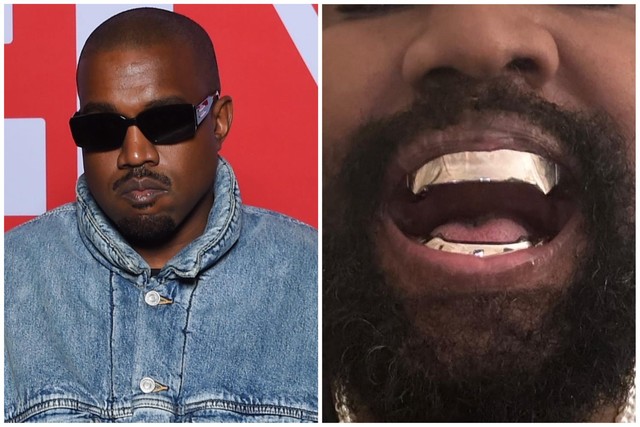 Kanye West gắn hàm răng giả hơn 20 tỉ đồng- Ảnh 1.