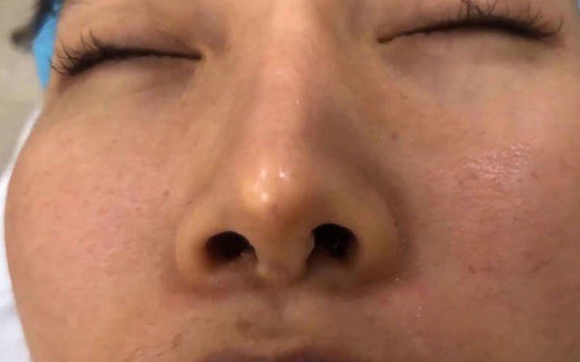 Sẹo lồi sau nâng mũi: Nguyên nhân và cách điều trị hiệu quả- Ảnh 1.