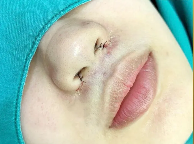 Sẹo lồi sau nâng mũi: Nguyên nhân và cách điều trị hiệu quả- Ảnh 2.
