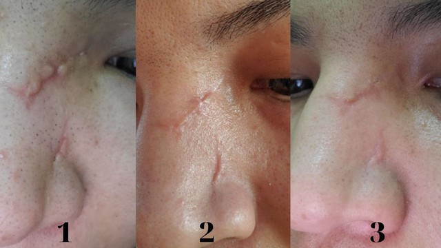 Sẹo lồi sau nâng mũi: Nguyên nhân và cách điều trị hiệu quả- Ảnh 8.