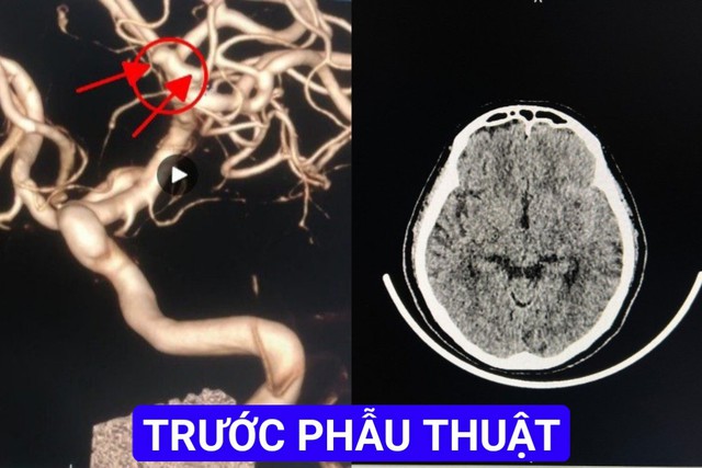 Cứu bệnh nhân bị xuất huyết dưới nhện do vỡ túi phình động mạch não- Ảnh 1.