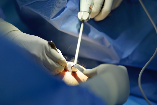 Phẫu thuật nâng ngực bằng dao siêu âm thế hệ mới Ultrasonic surgical scalpel- Ảnh 1.