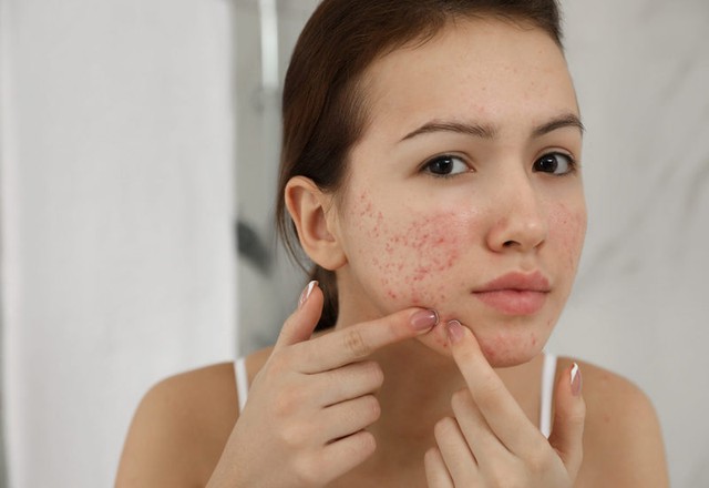 Góc giải đáp thắc mắc: Sẹo rỗ do nặn mụn, dùng kem trị sẹo có hết không?- Ảnh 2.