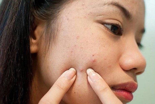 Góc giải đáp thắc mắc: Sẹo rỗ do nặn mụn, dùng kem trị sẹo có hết không?- Ảnh 3.