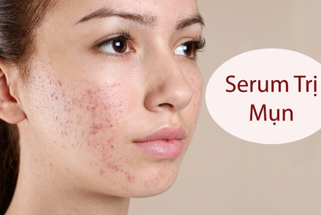 serum trị mụn