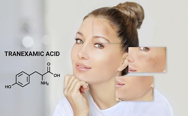 Top 3 Tranexamic Acid trị nám ‘đỉnh cao’ cho làn da trắng sáng- Ảnh 1.