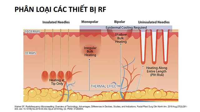 Ứng dụng RF vi kim trong điều trị sẹo lõm- Ảnh 2.