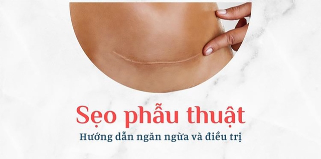 Làm thế nào để ngăn ngừa và điều trị sẹo sau phẫu thuật hiệu quả tại nhà?- Ảnh 1.