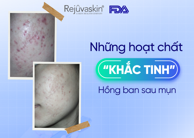 Top những thành phần 'khắc tinh' hồng ban sau mụn- Ảnh 1.