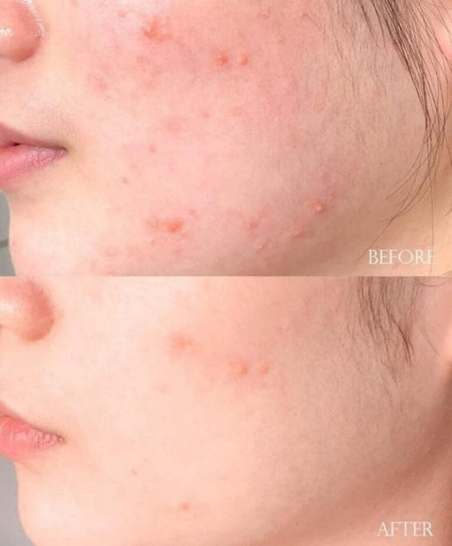 Top 10 sữa rửa mặt trị mụn được tín đồ skincare review nhiều hàng đầu hiện nay- Ảnh 11.