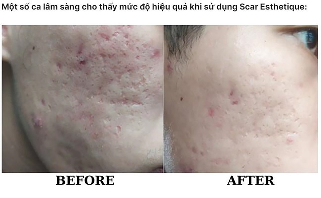 Top 10 serum trị thâm mụn cho làn da tươi sáng rạng ngời được tìm mua nhiều- Ảnh 5.