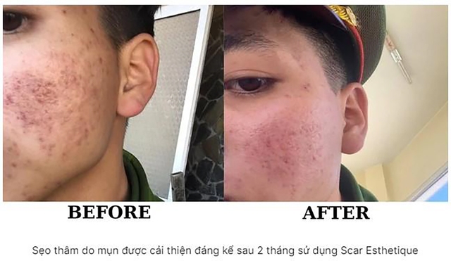 Top 10 serum trị thâm mụn cho làn da tươi sáng rạng ngời được tìm mua nhiều- Ảnh 6.