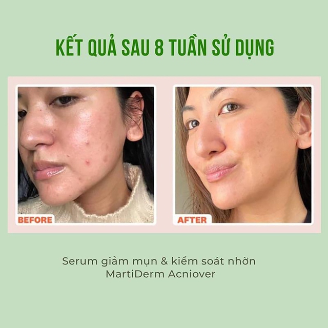 Top 10 serum trị thâm mụn cho làn da tươi sáng rạng ngời được tìm mua nhiều- Ảnh 10.