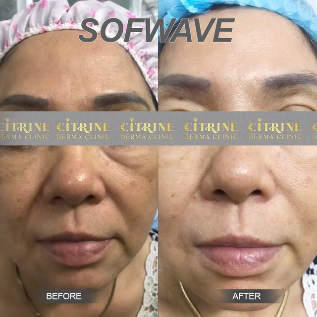 Hình ảnh khách hàng trước và sau khi thực hiện liệu trình trẻ hóa tại Citrine Derma Clinic