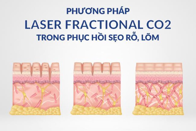 Tối ưu hiệu quả điều trị sẹo rỗ: Kết hợp laser và Scar Esthetique tại nhà- Ảnh 2.