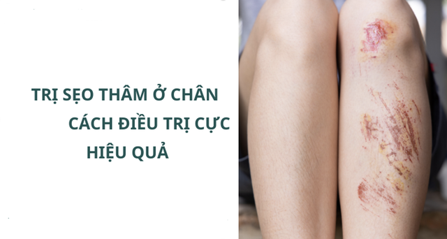 Kem trị sẹo thâm ở chân nào hiệu quả ngay tại nhà mà không cần xâm lấn?- Ảnh 1.