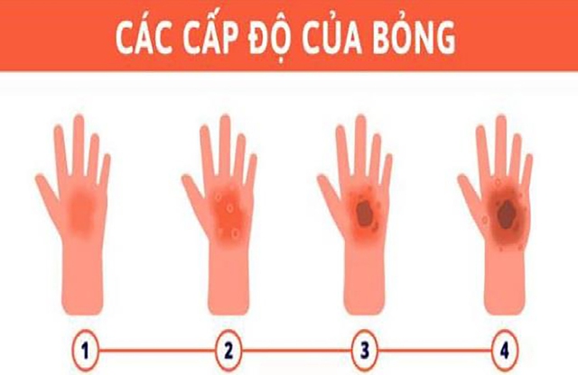 Bật mí ‘siêu phẩm’ kem trị sẹo bỏng dù có hết tiền vẫn phải mua lại- Ảnh 2.